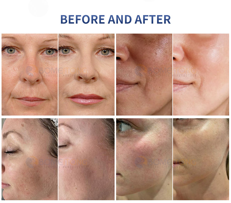 Jet Peel Water professional microdermabrasion machine for estheticians