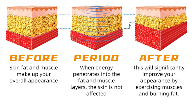 Ems Cryo Pads Machine Body Sculpting 8pcs Flat Cryolipolysis
