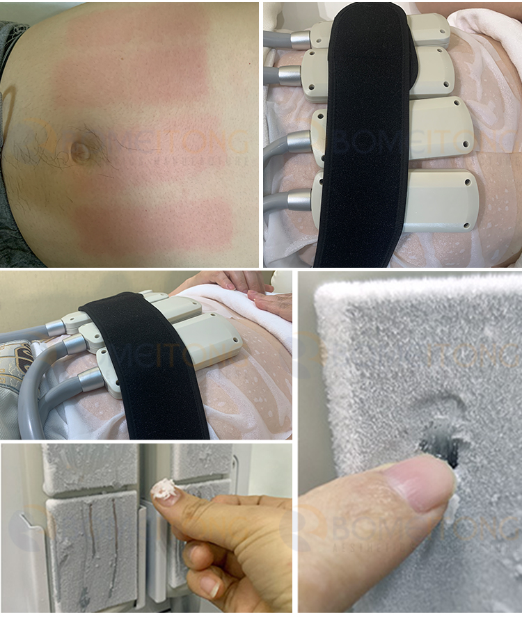 Ems Cryo Pads Machine Body Sculpting 8pcs Flat Cryolipolysis