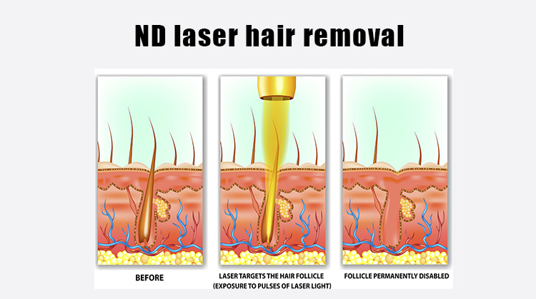 nd-yag-laser