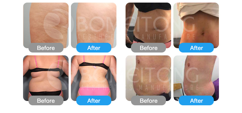 Cryo cellulite new arrival physical therapy shockwave for sale