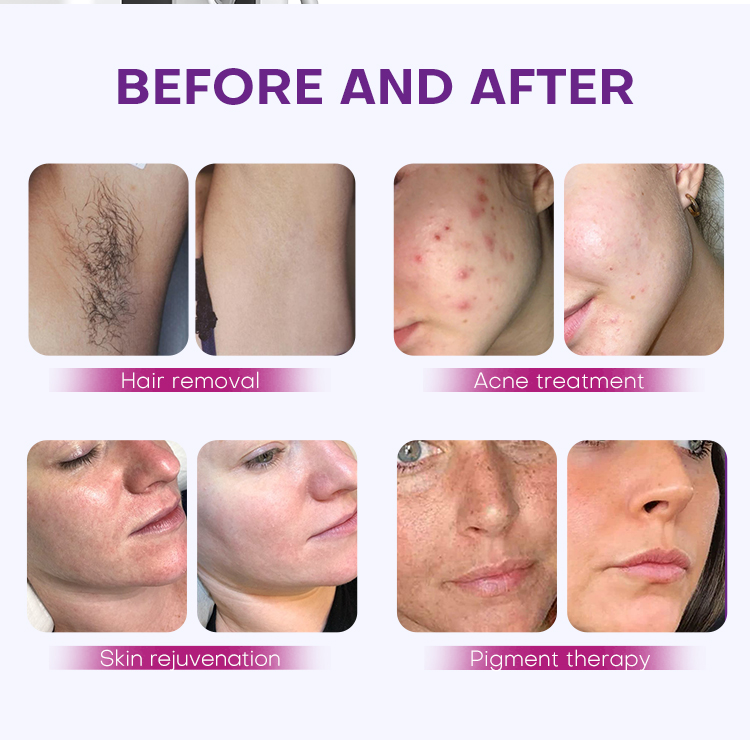 shr hair removal machine