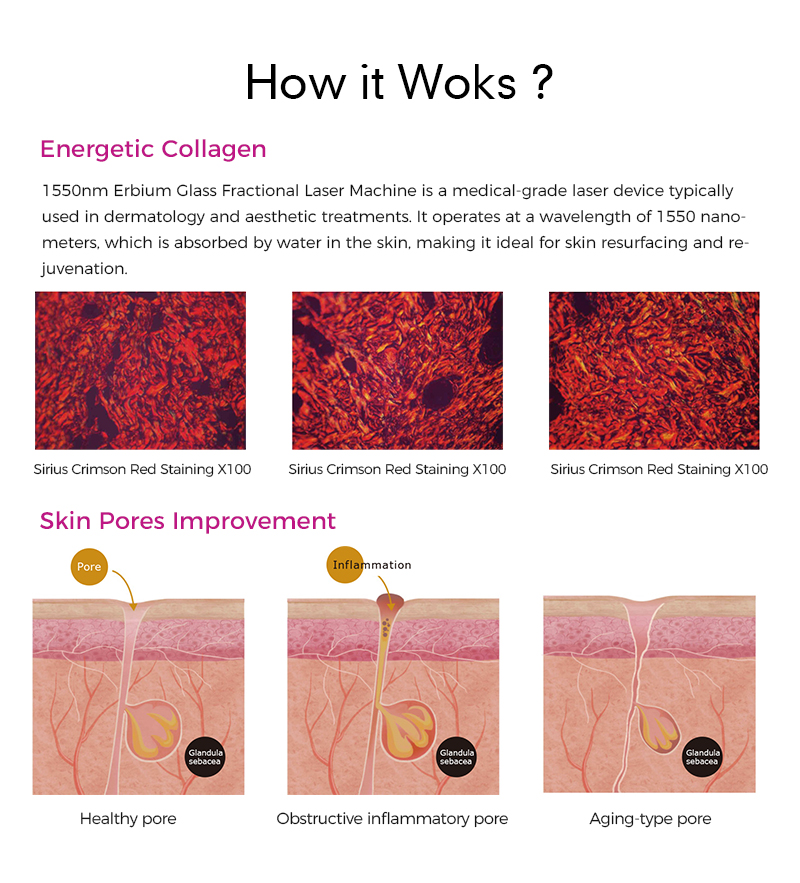 1550nm Erbium Laser Machine