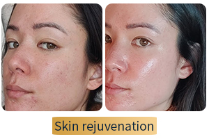 skin rejuvenation