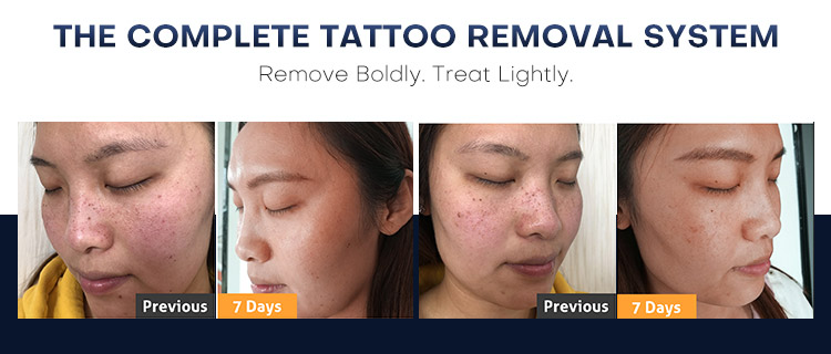 Switched Nd Yag Laser Tattoo Removal Machine for Sale