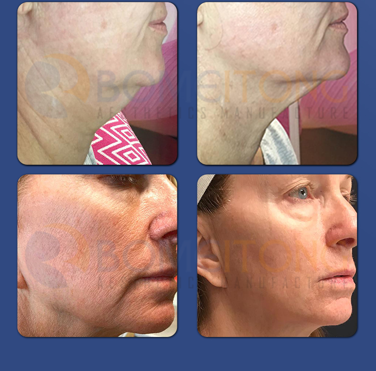 Dermo Electro Poration skin firming ion vibration device Dermoelectroporation