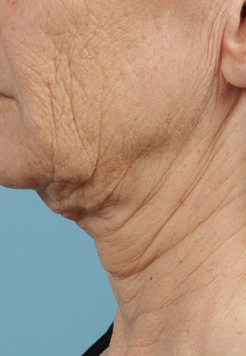  Skin Tightening
