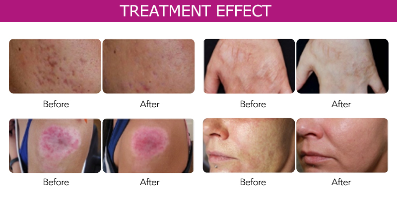 Professional Rf Microneedling Machine