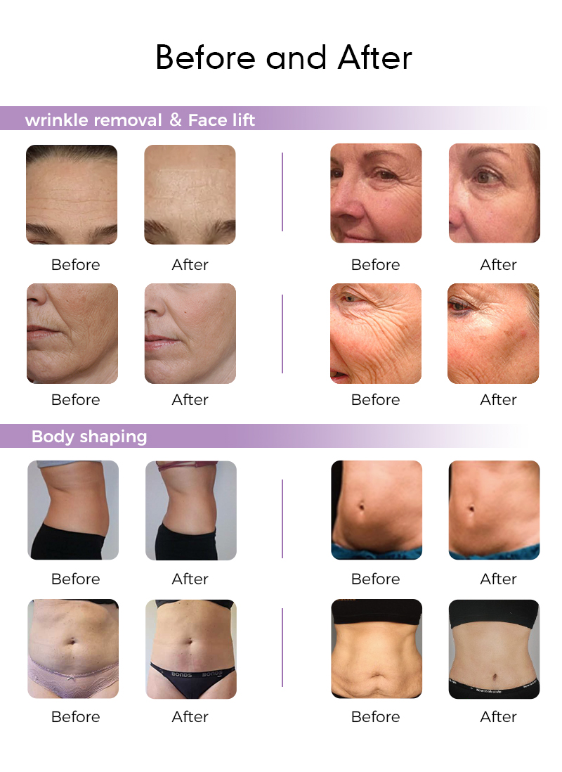 Highly advanced hifu equipment