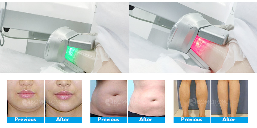 cool wave treatment result