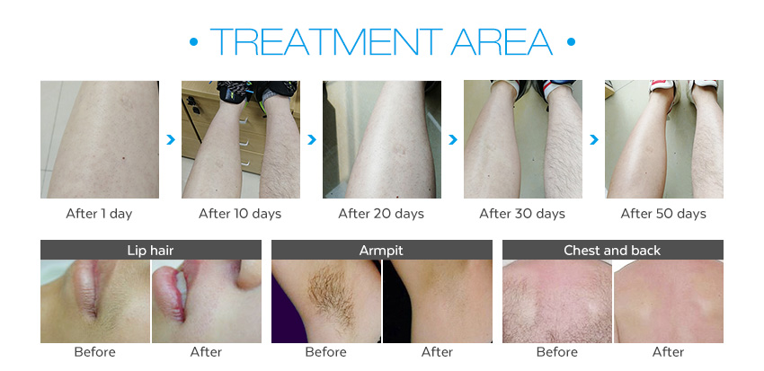 Laser hair removal face men machine skin rejuvenation beauty salon