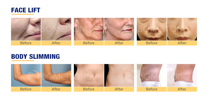 4d Hifu Wrinkle Removal Radar Line Carve 2 in 1 Face Lifting Machine HIF3-4S