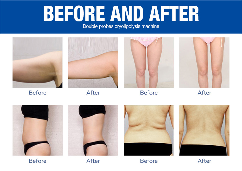 fat freezing equipments good results