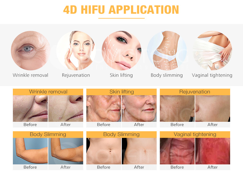 Hifu 4d Korea Professional Smas Face Lifting Machine for Sale Uk