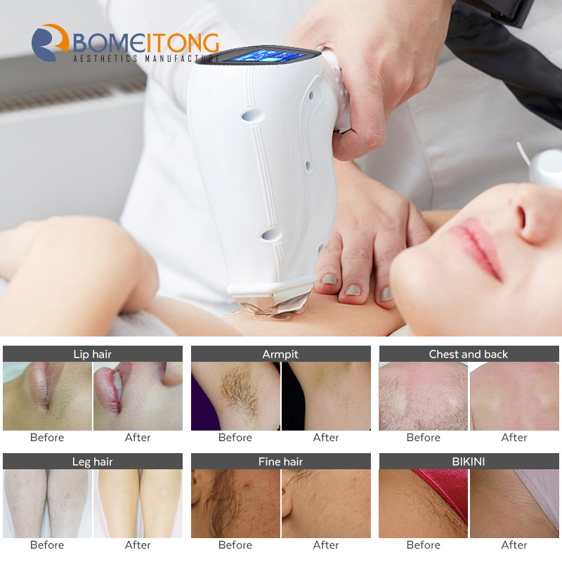 hair removal 808nm diode laser newest beauty machine