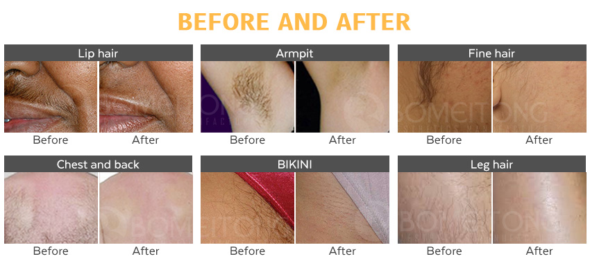 1200W Professional 808nm Diode Hair Removal Equipment Machine BM101